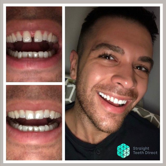 Straight Teeth Direct Review by Anthony