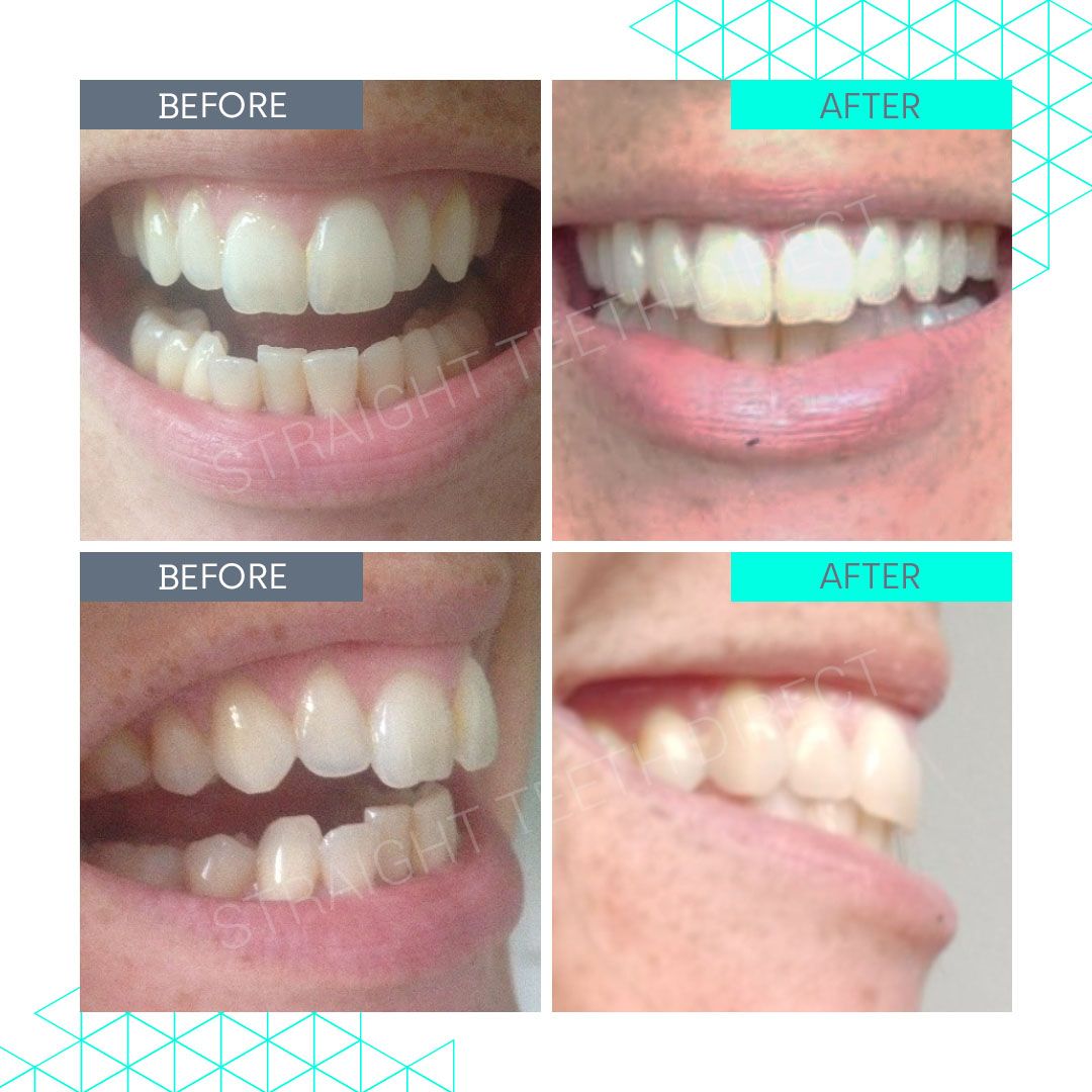 Straight Teeth Direct Review by