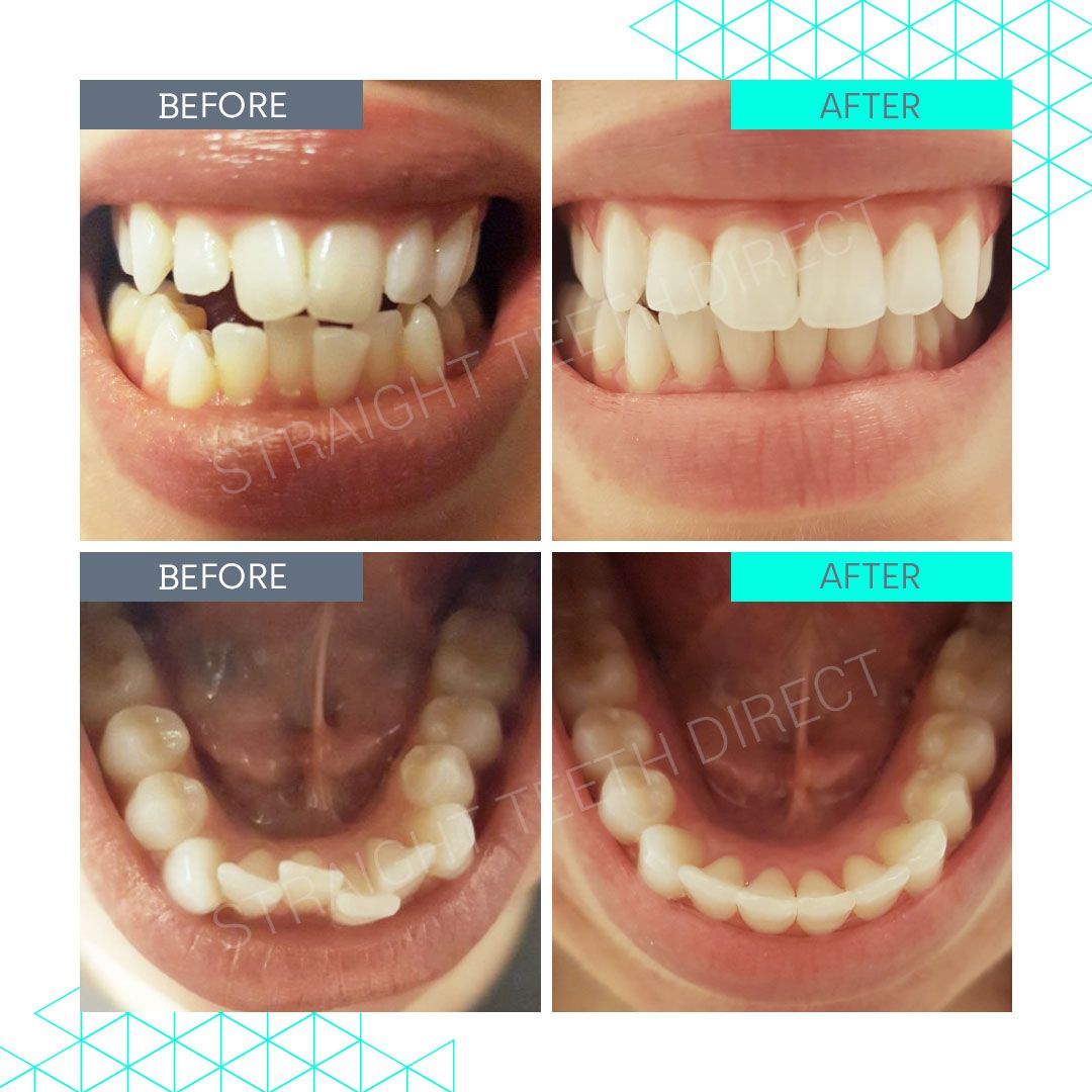 Straight Teeth Direct Review by Catherine Kiev
