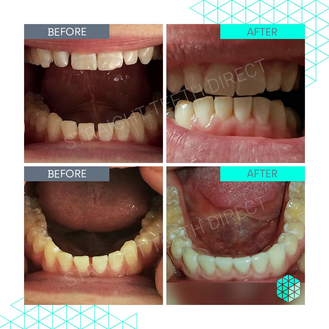 Straight Teeth Direct Review by CJ
