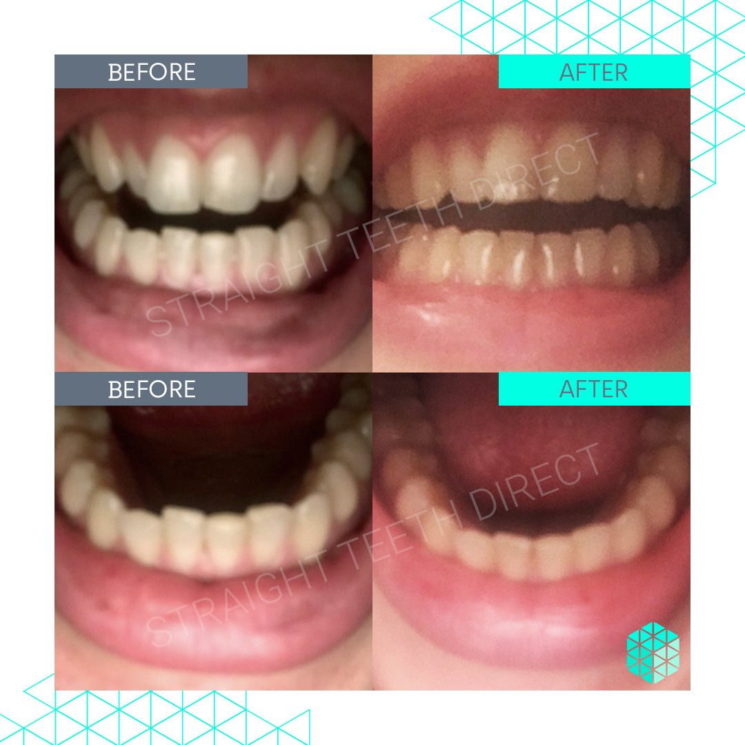 Straight Teeth Direct Review by Dani-Rose O Ryan