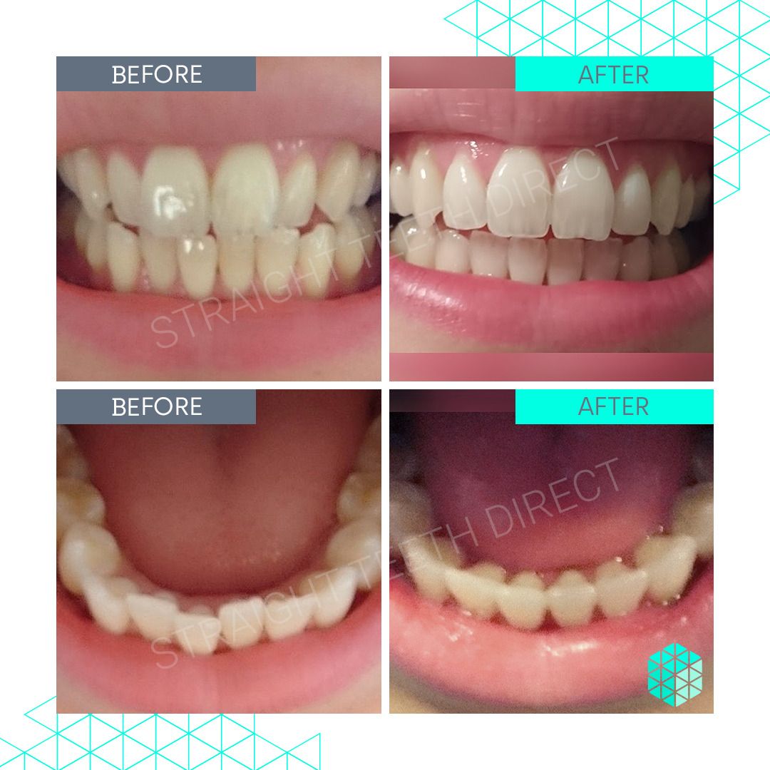 Straight Teeth Direct Review by Dani