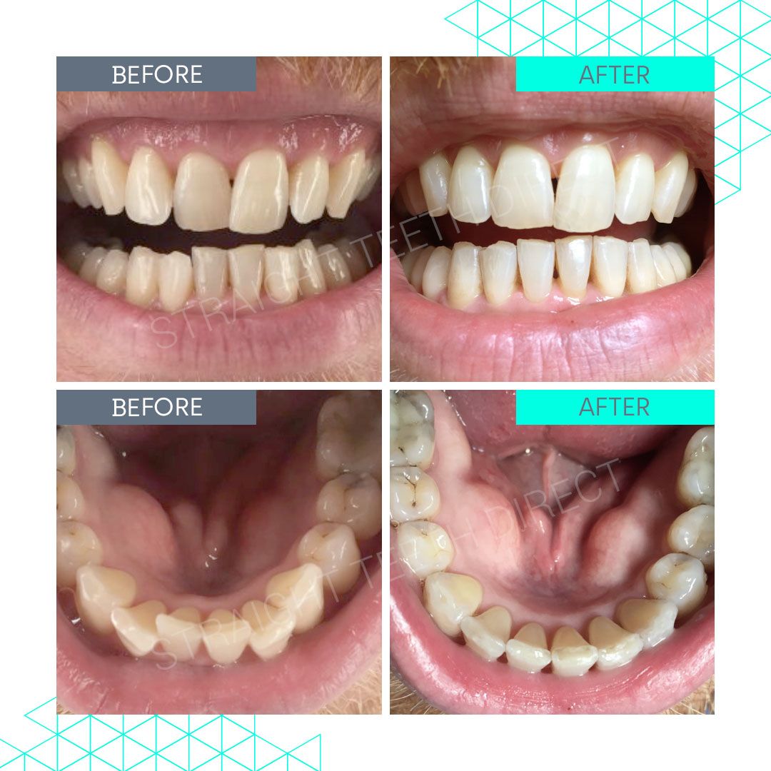 Straight Teeth Direct Review by Danny