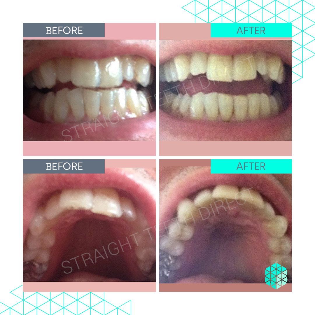 Straight Teeth Direct Review by David D