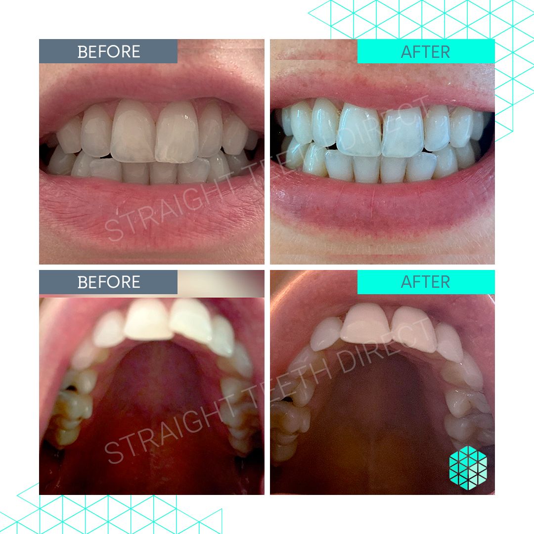 Straight Teeth Direct Review by Emma P