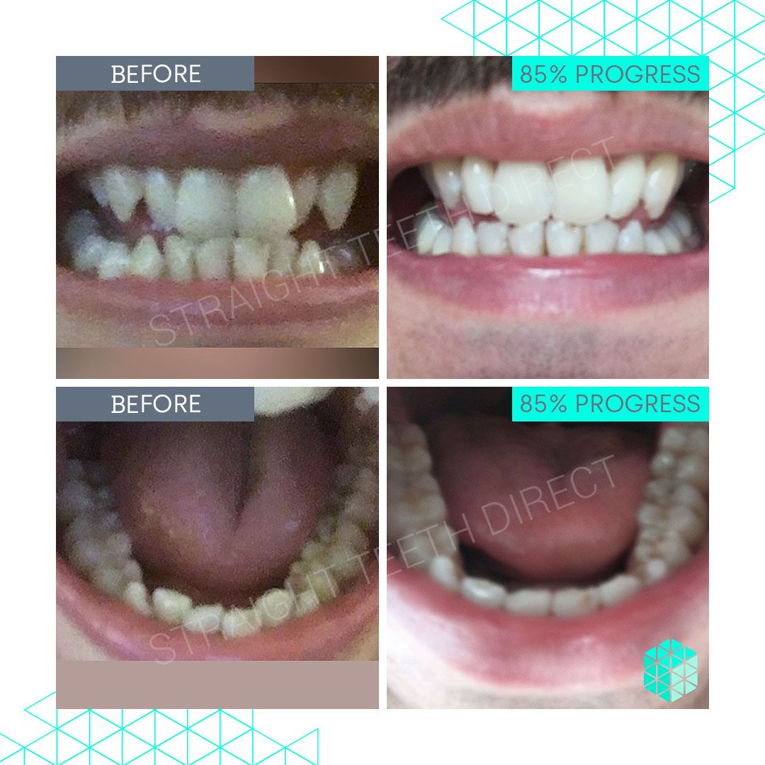 Straight Teeth Direct Review by Gary