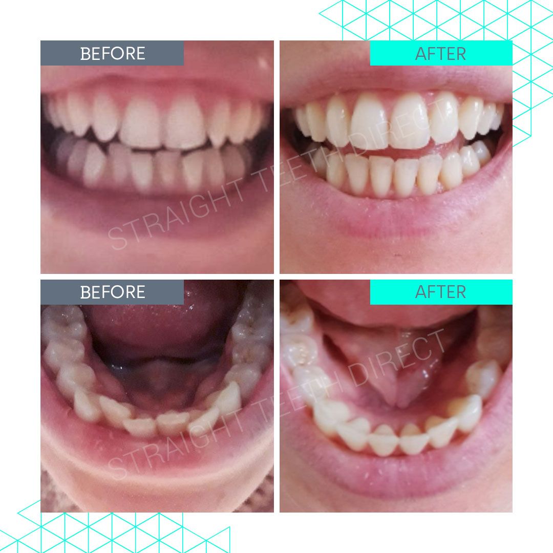 Straight Teeth Direct Review by Gemma