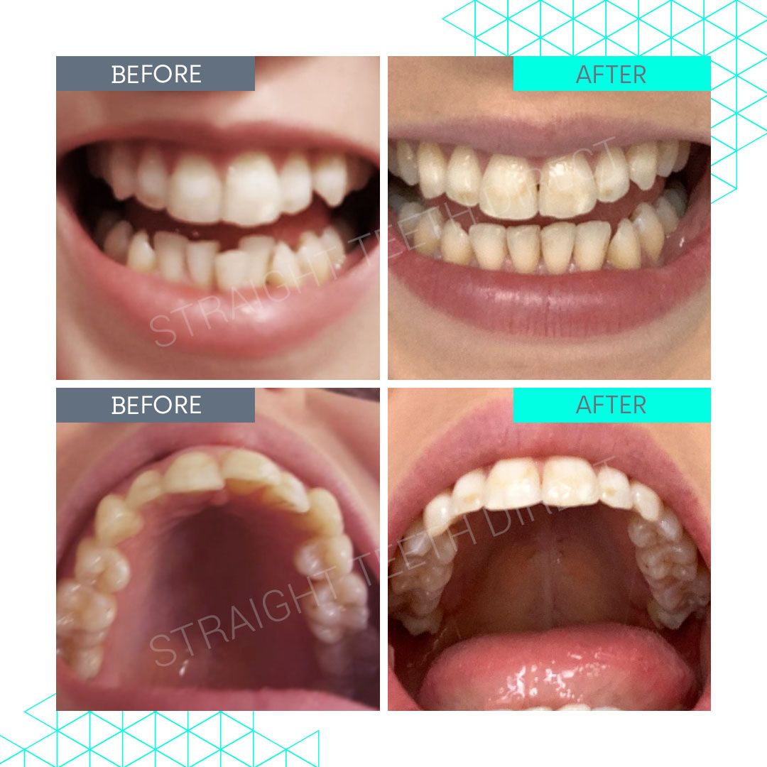 Straight Teeth Direct Review by Harriet
