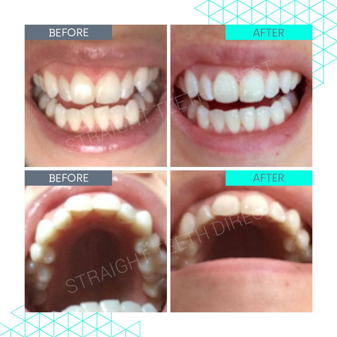 Straight Teeth Direct Review by Gemma