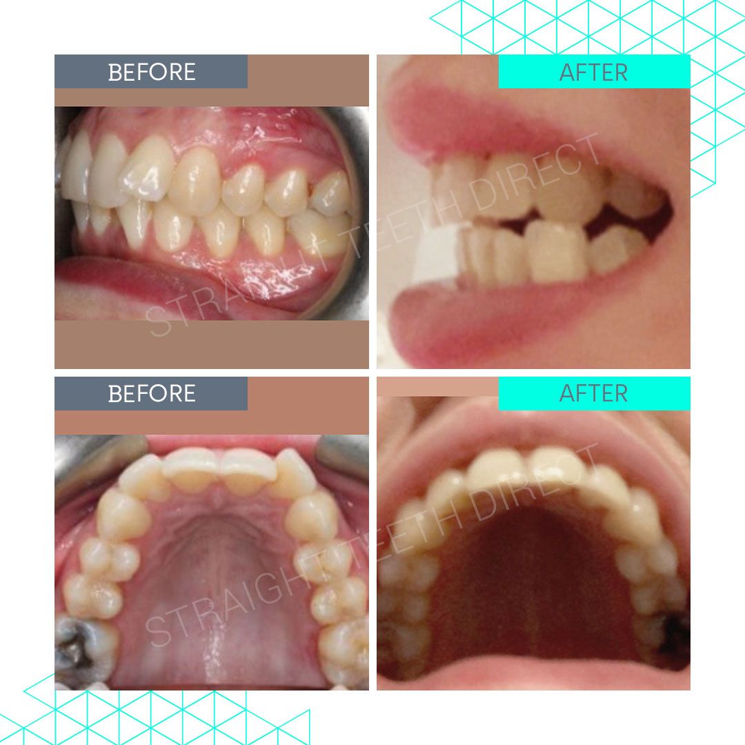 Straight Teeth Direct Review by Hollie