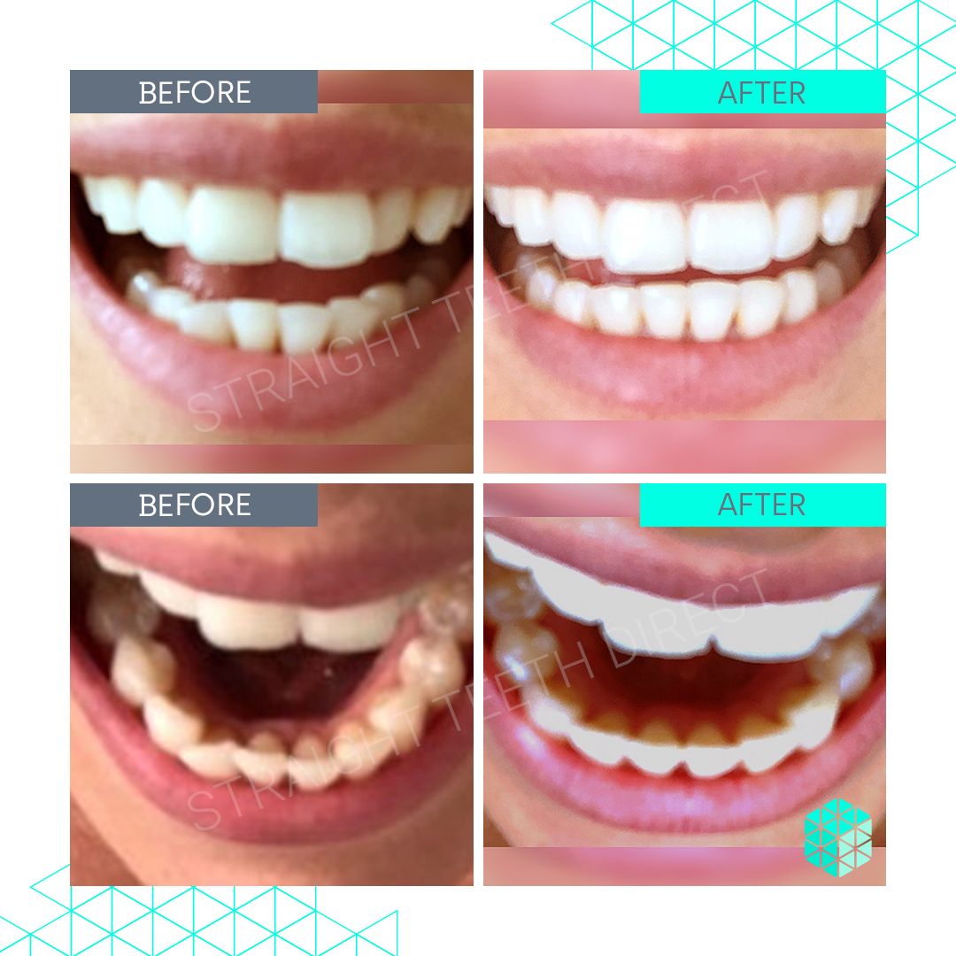 Straight Teeth Direct Review by