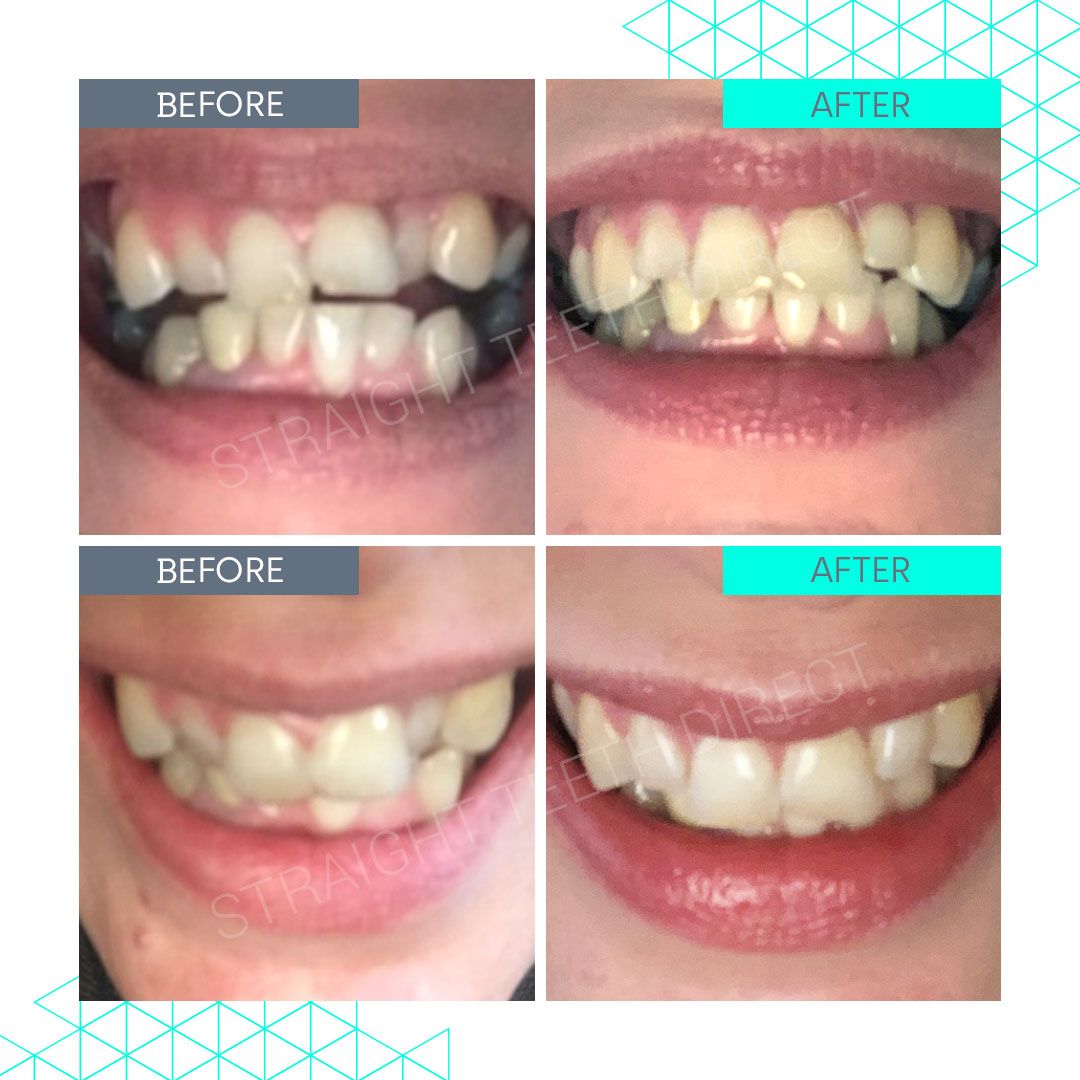 Straight Teeth Direct Review by Jo Bray