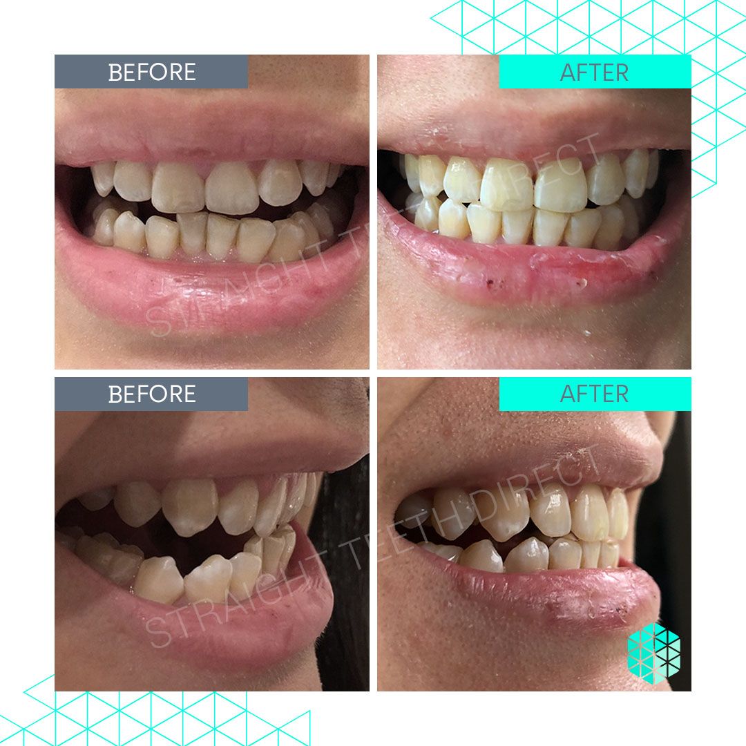 Straight Teeth Direct Review by Juli