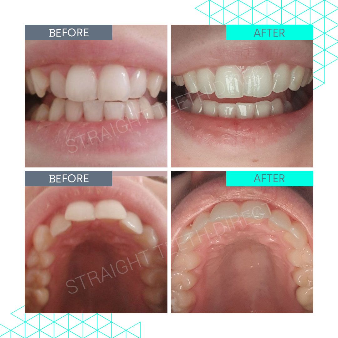 Straight Teeth Direct Review by Lauren