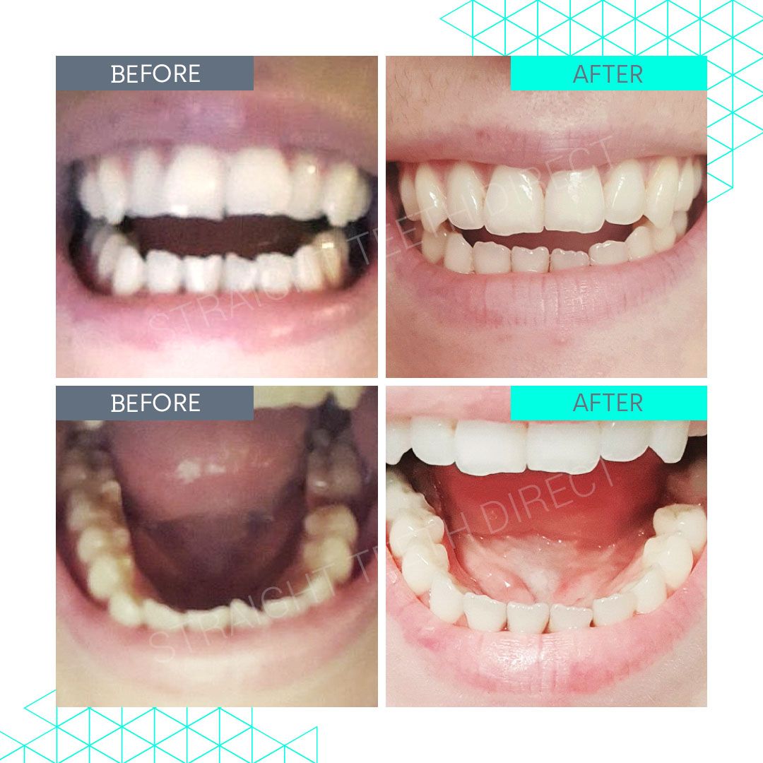 Straight Teeth Direct Review by