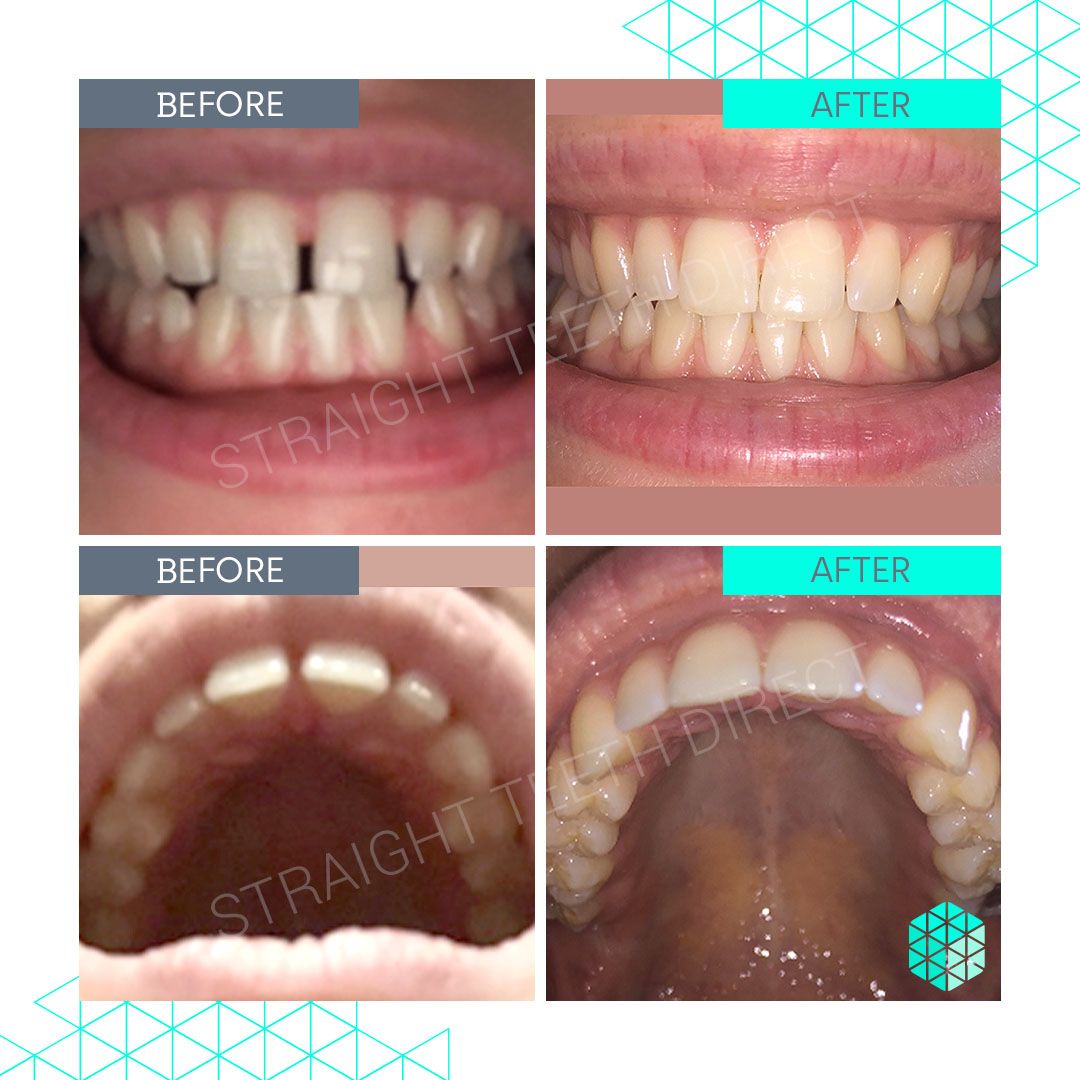 Straight Teeth Direct Review by Liv