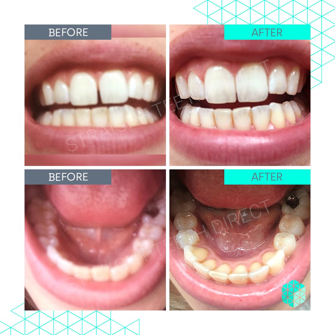 Straight Teeth Direct Review by