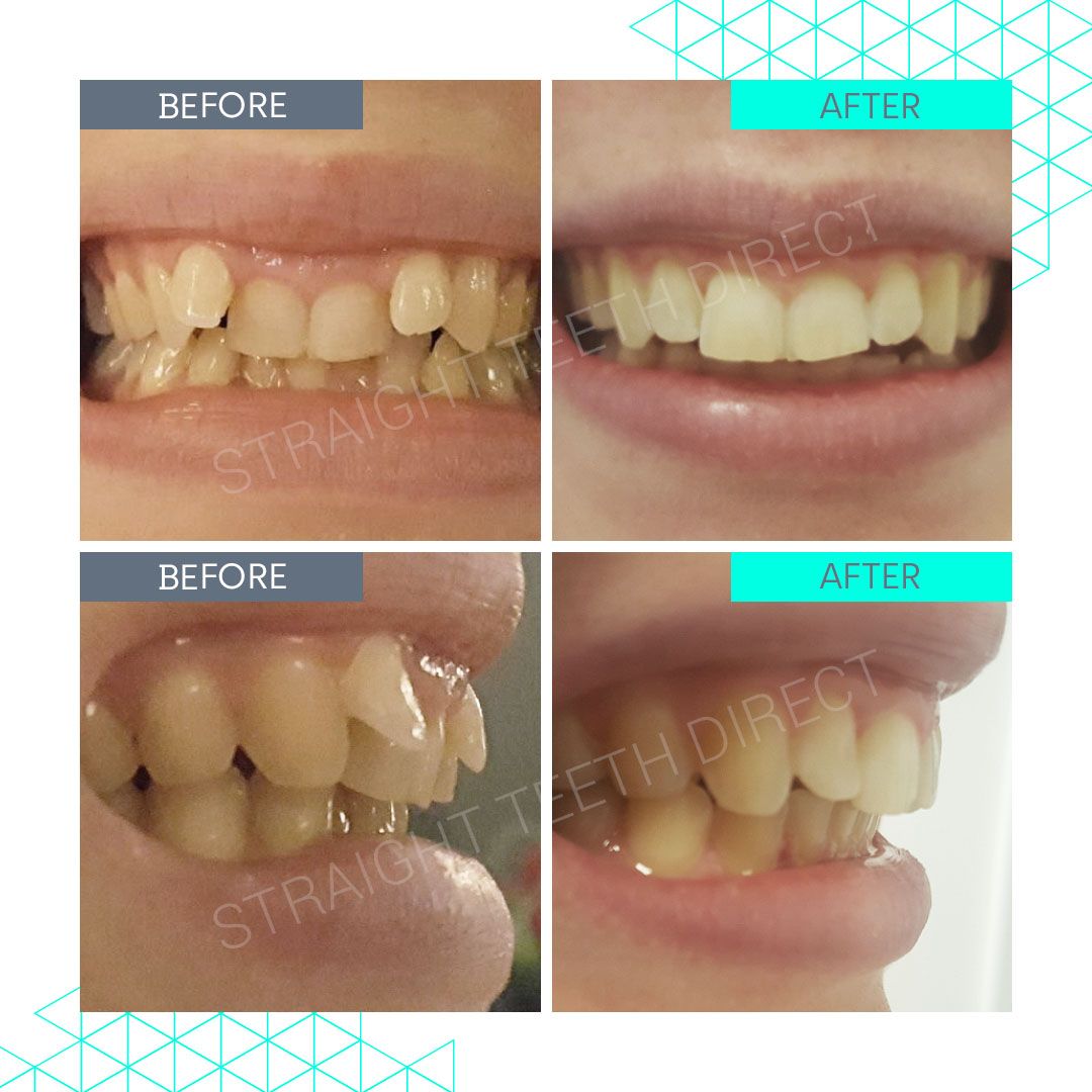 Straight Teeth Direct Review by Lydia