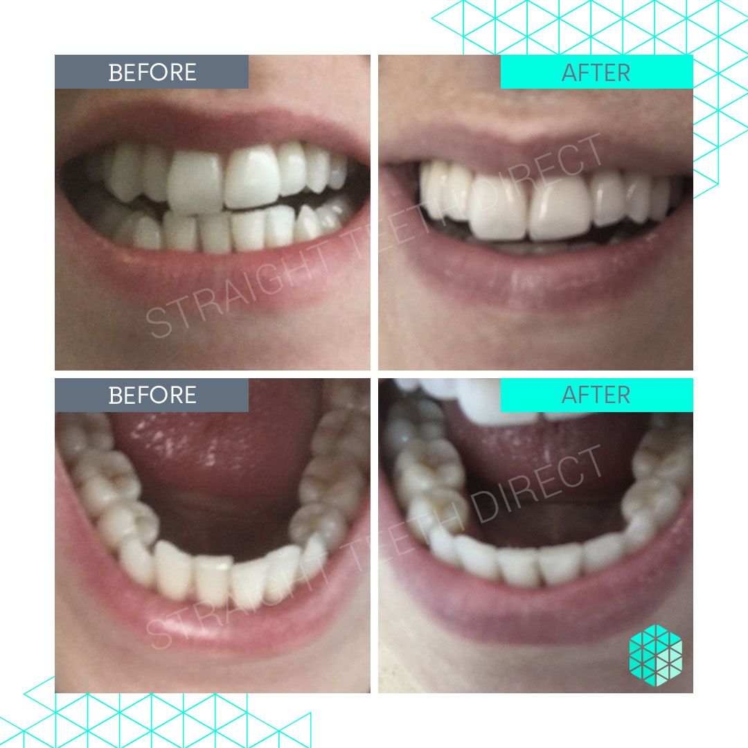 Straight Teeth Direct Review by Maisie