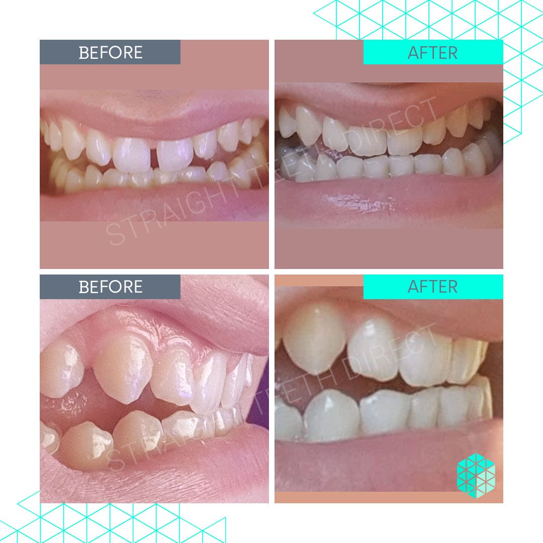 Straight Teeth Direct Review by Matt