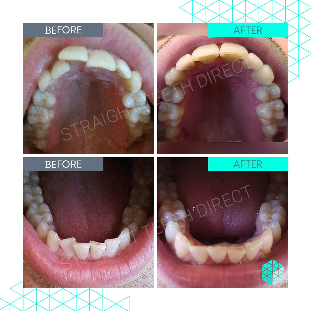 Straight Teeth Direct Review by