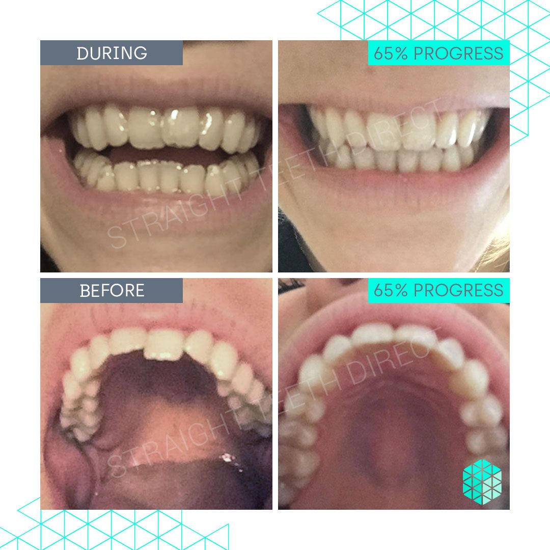 Straight Teeth Direct Review by Mimi