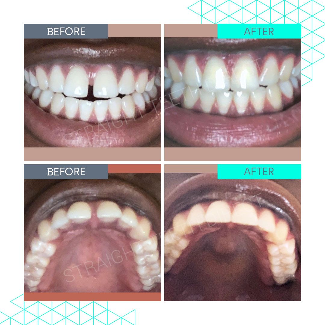 Straight Teeth Direct Review by Tina