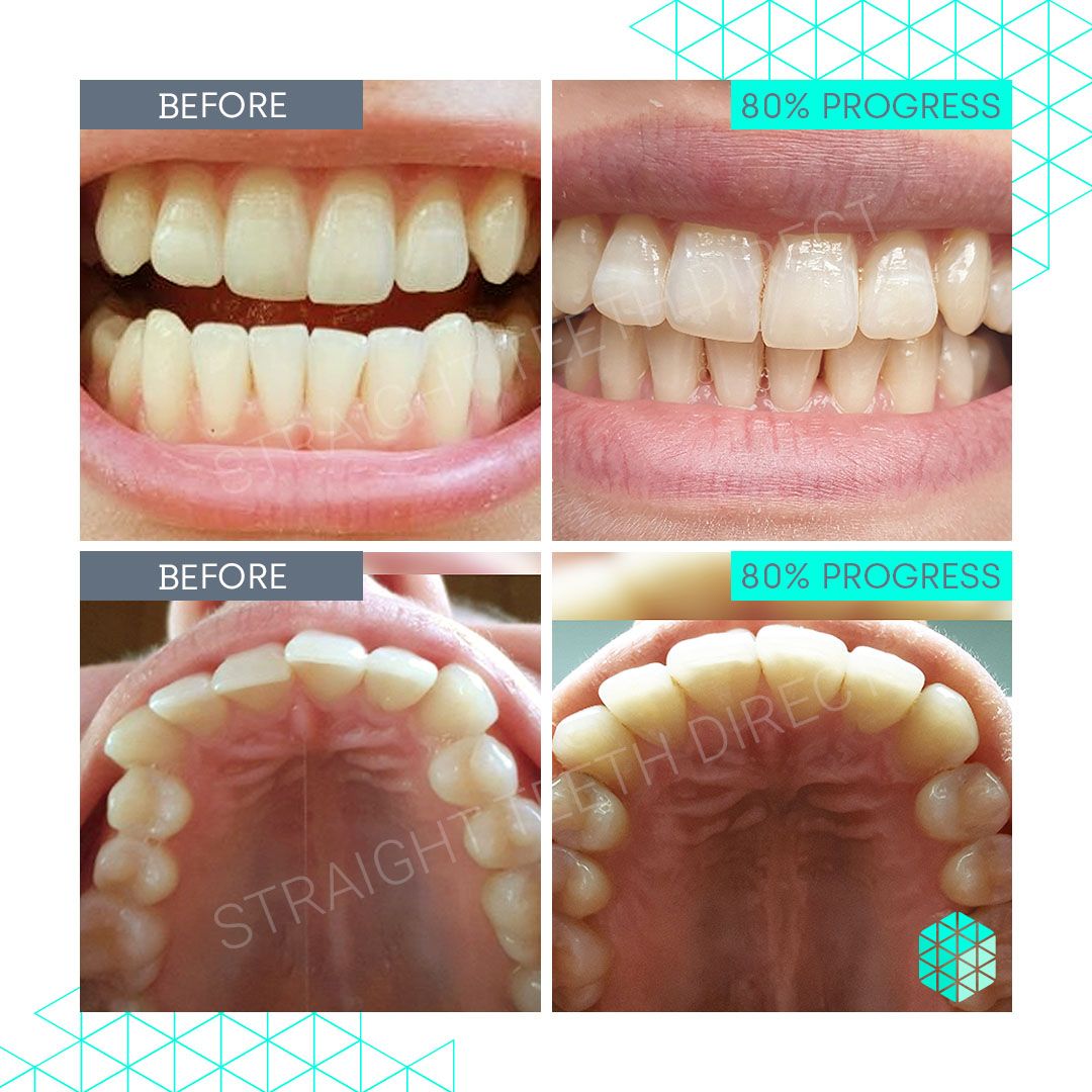 Straight Teeth Direct Review by Nastja