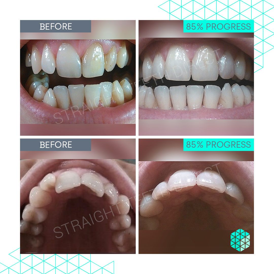 Straight Teeth Direct Review by Natasha R.