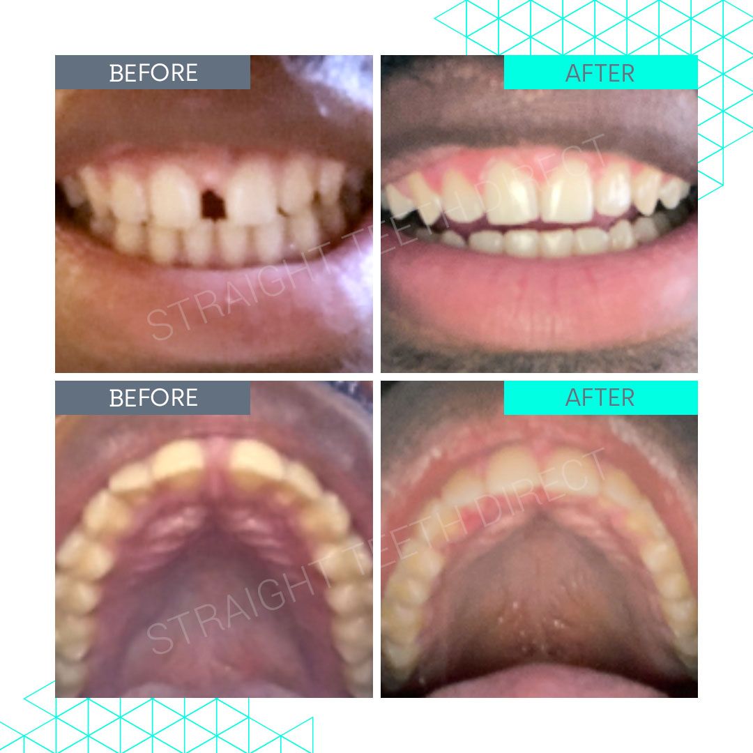 Straight Teeth Direct Review by Peter