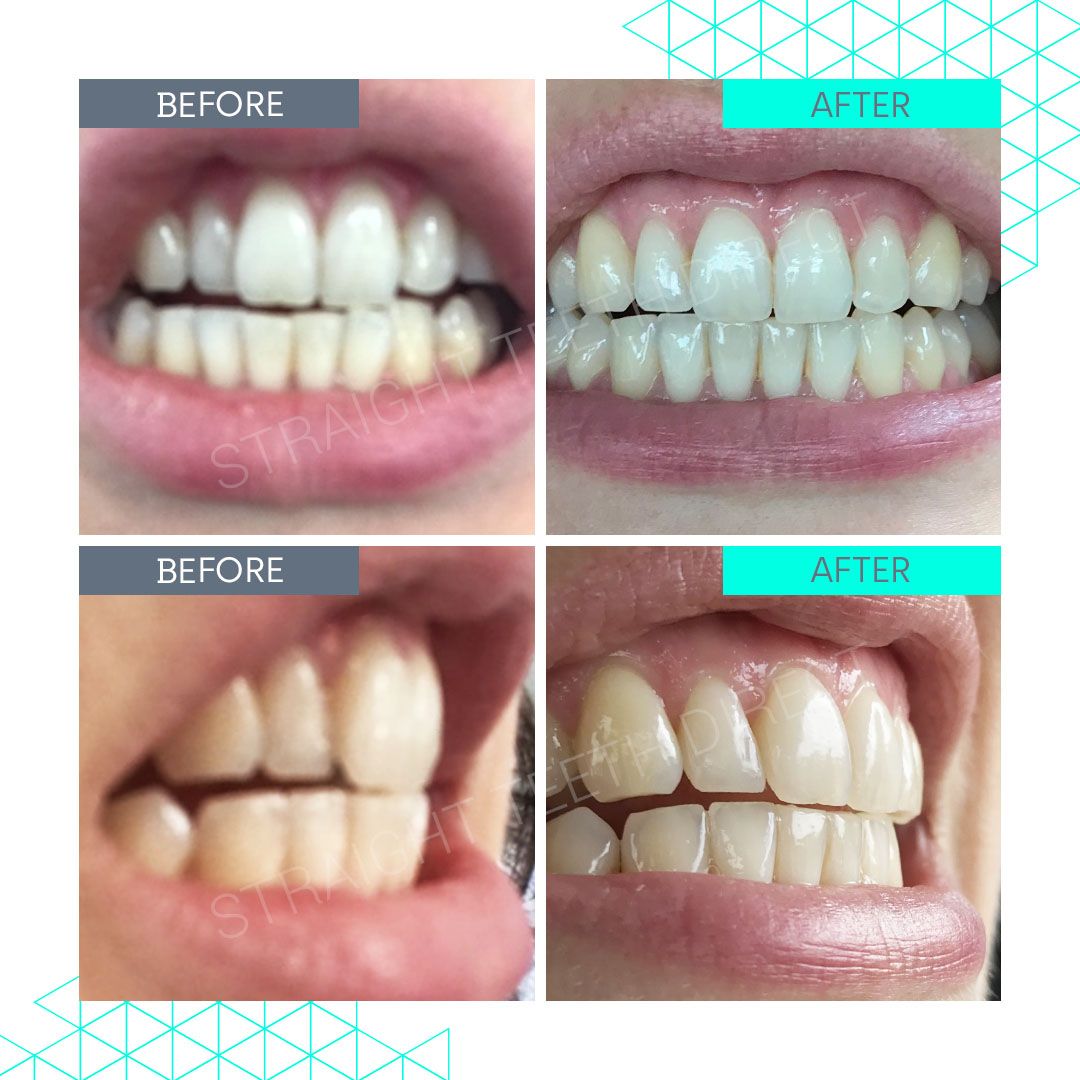 Straight Teeth Direct Review by Rachel