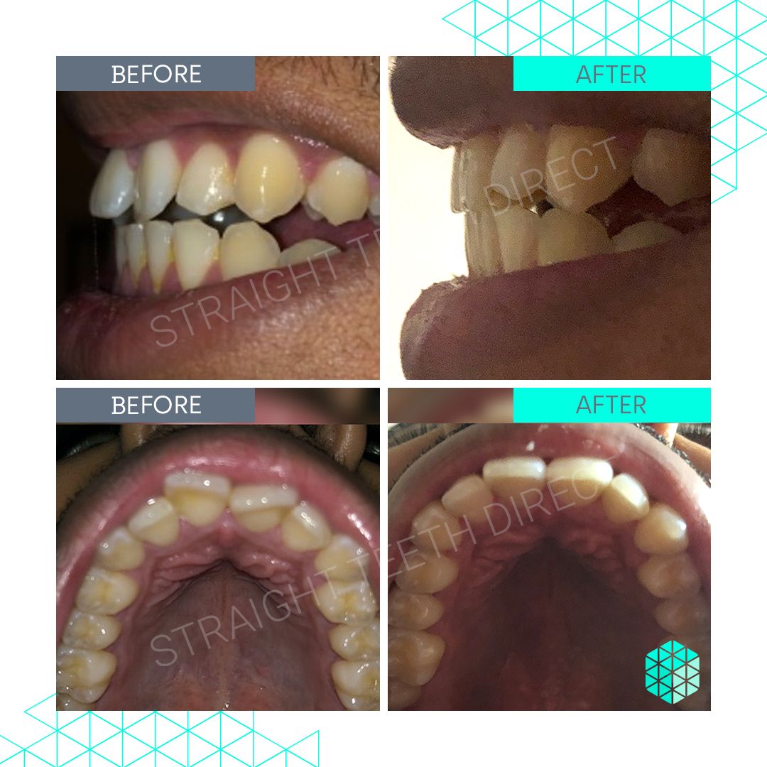 Straight Teeth Direct Review by