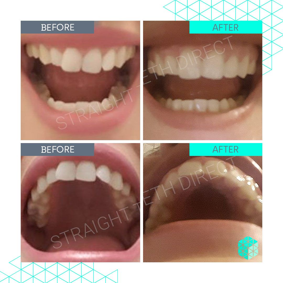 Straight Teeth Direct Review by Sian Williams