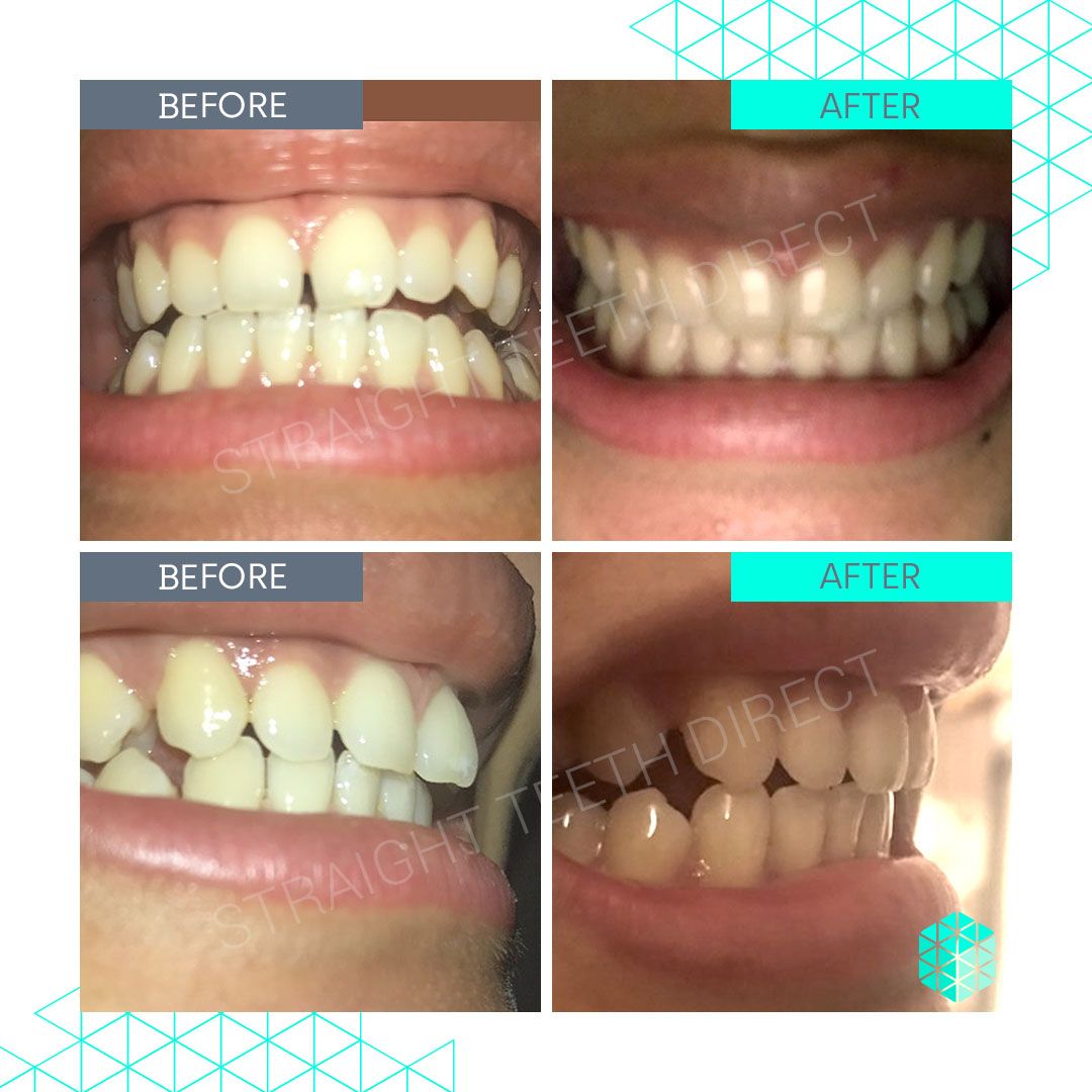 Straight Teeth Direct Review by Stella