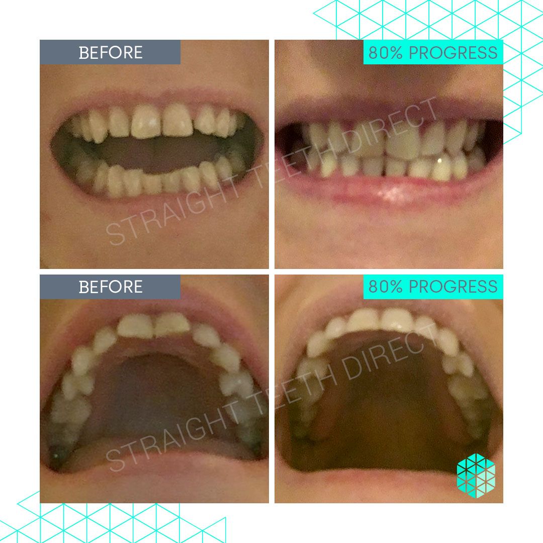 Straight Teeth Direct Review by Tiffany