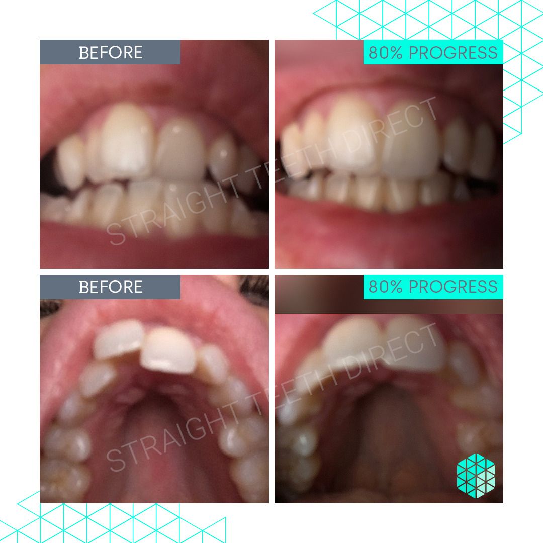 Straight Teeth Direct Review by Victoria