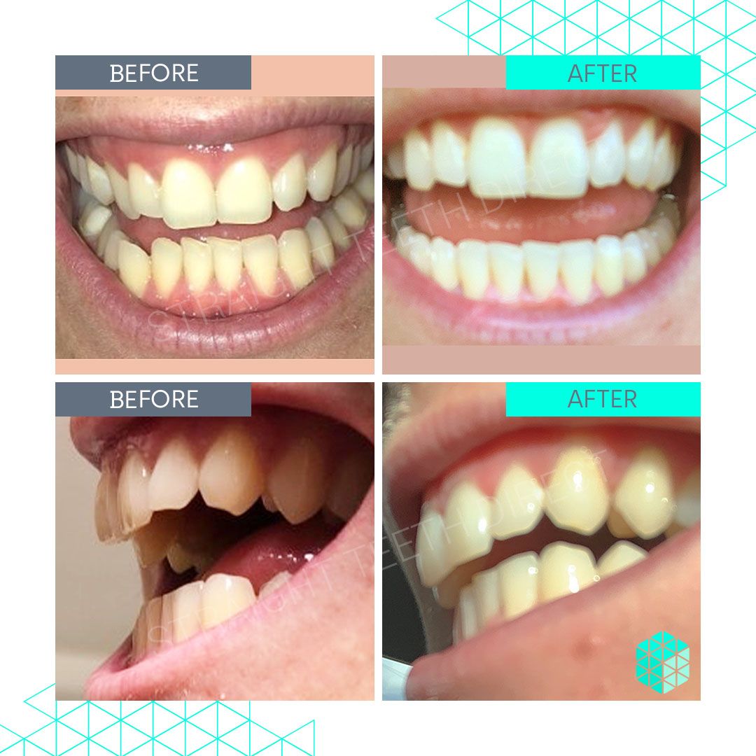 Straight Teeth Direct Review by