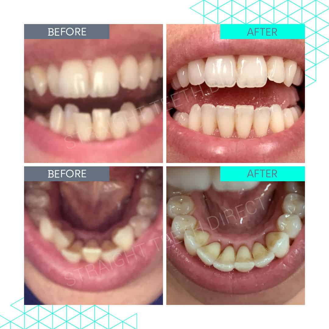 Straight Teeth Direct Review by Fifi