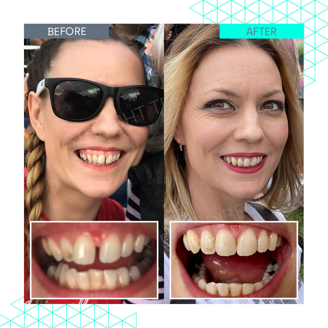 Straight Teeth Direct Review by Adrienne