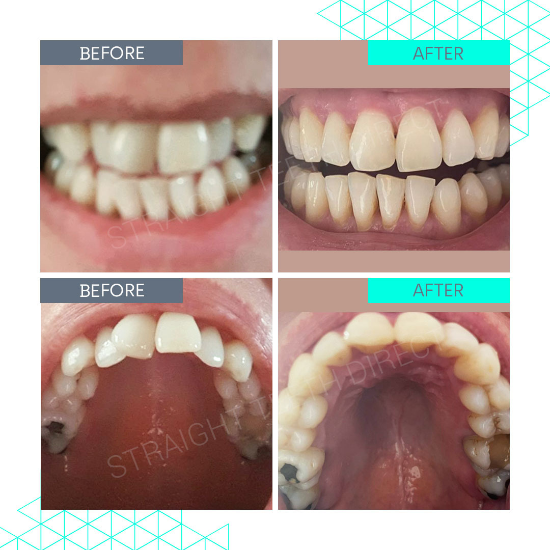 Straight Teeth Direct Review by Tracey