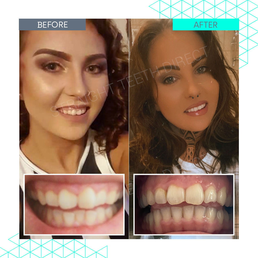 Straight Teeth Direct Review by Nicole Rumbelow