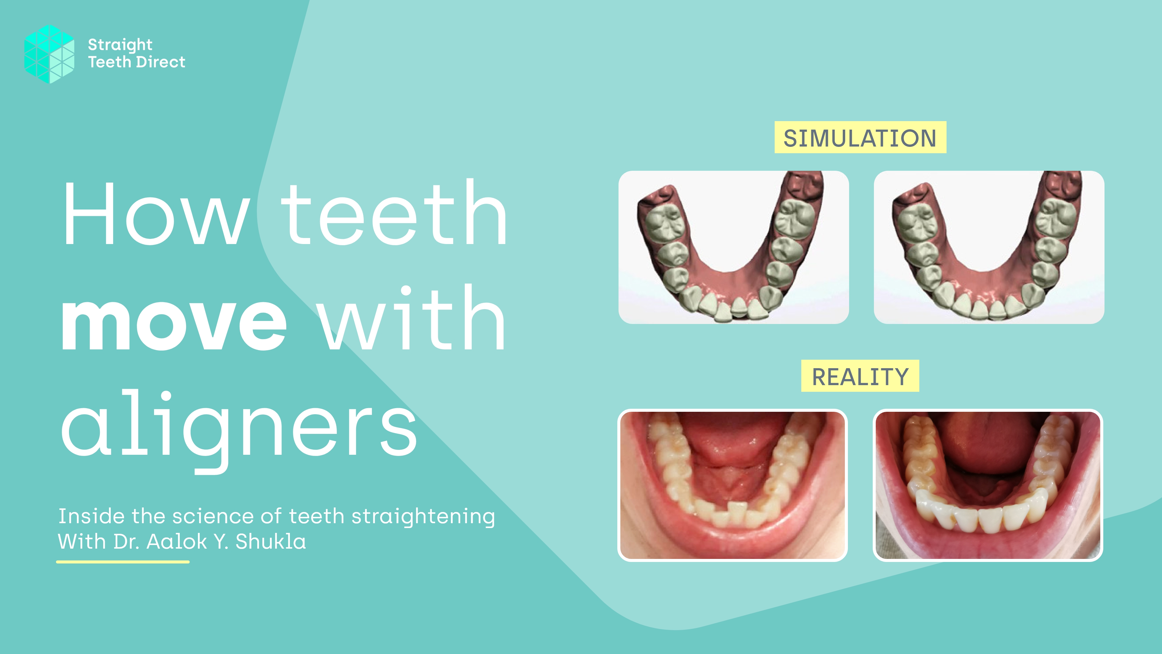 Orthodontics / Invisible / Clear Braces - Dr. Shukla's Dent Care