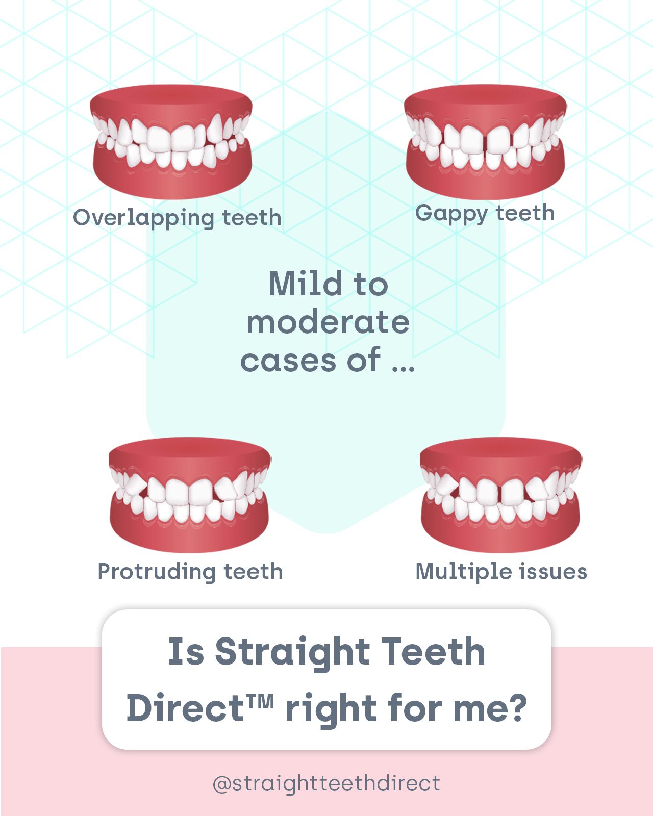 is Straight Teeth Direct right for me?