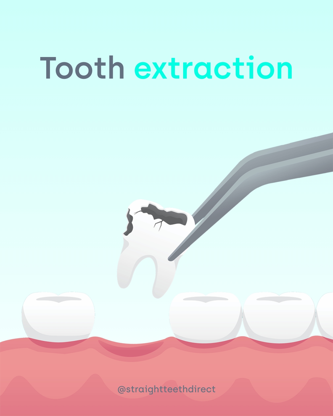 Tooth extraction