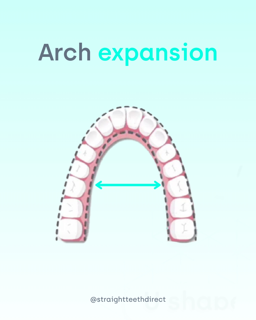 Arch expansion