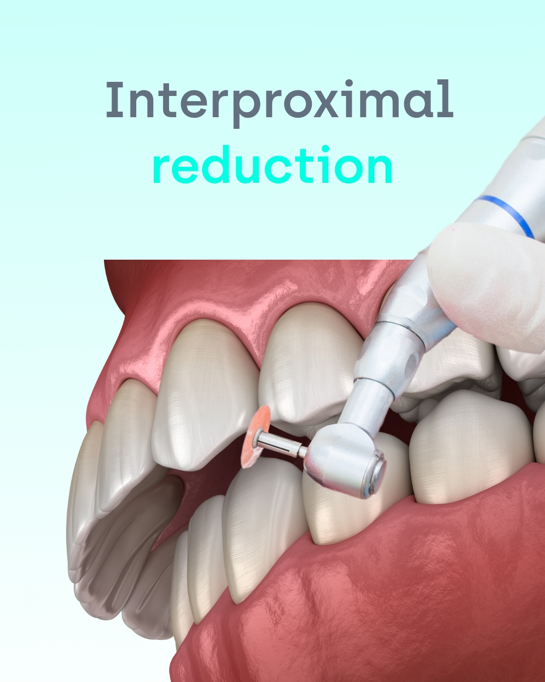 Interproximal Reduction