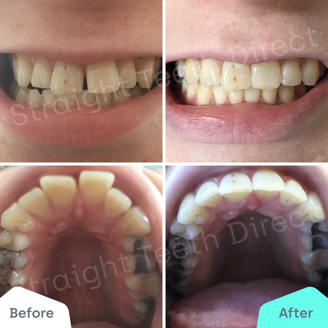 Straight Teeth Direct Review by Isabel