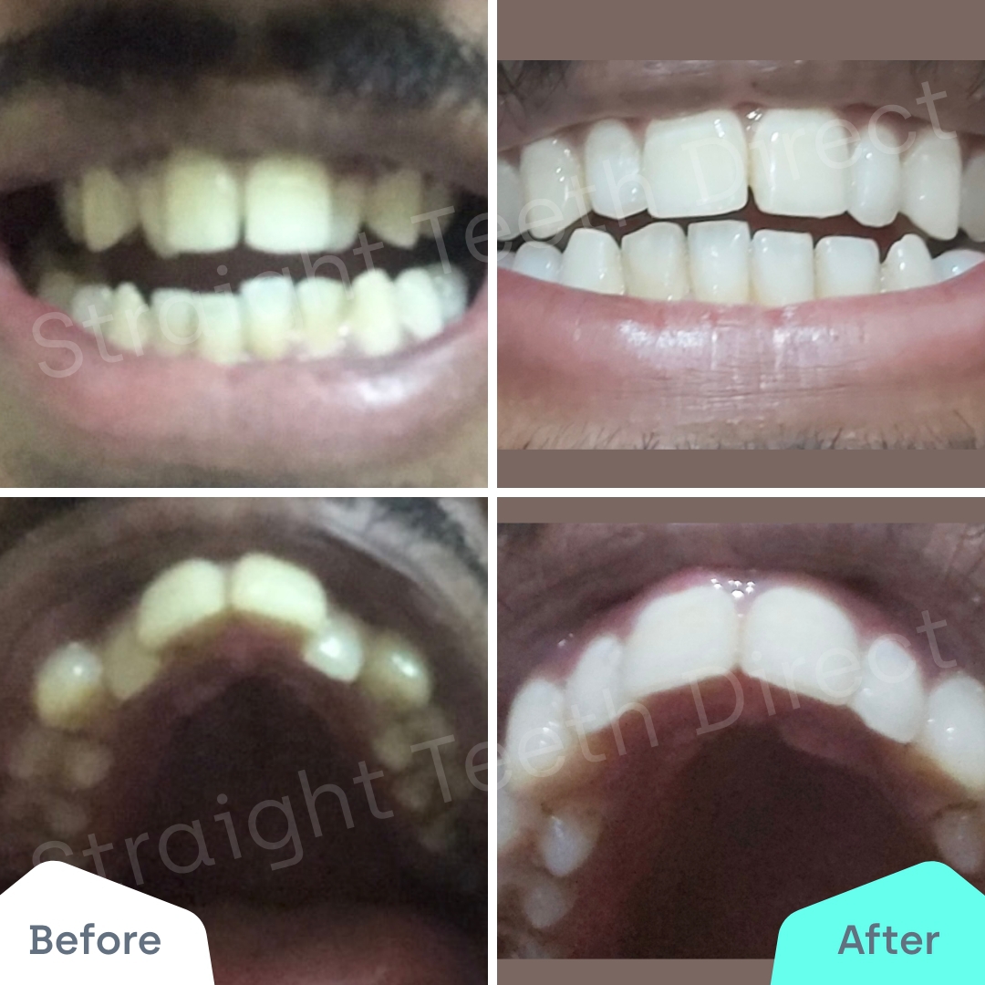 Straight Teeth Direct Review by Vivek Verma