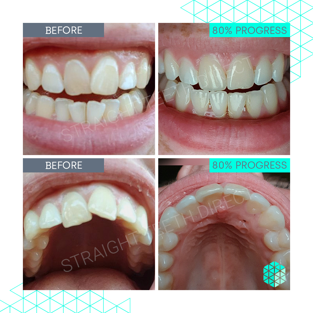 Straight Teeth Direct Review by Olivia