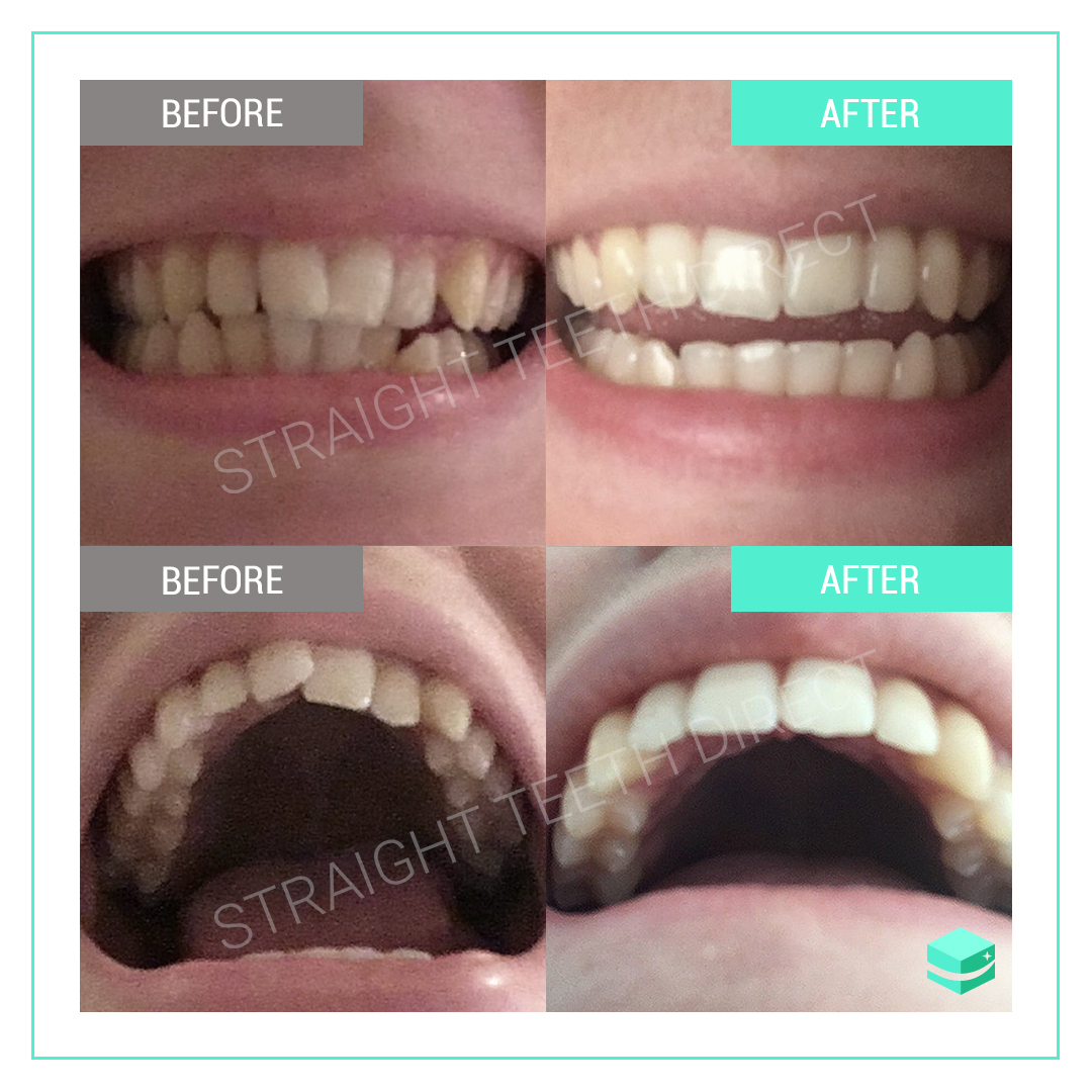 Straight Teeth Direct Review by Katie